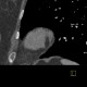 Lipoma of left ventricle: CT - Computed tomography